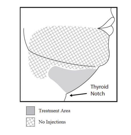 kybella injection site areas