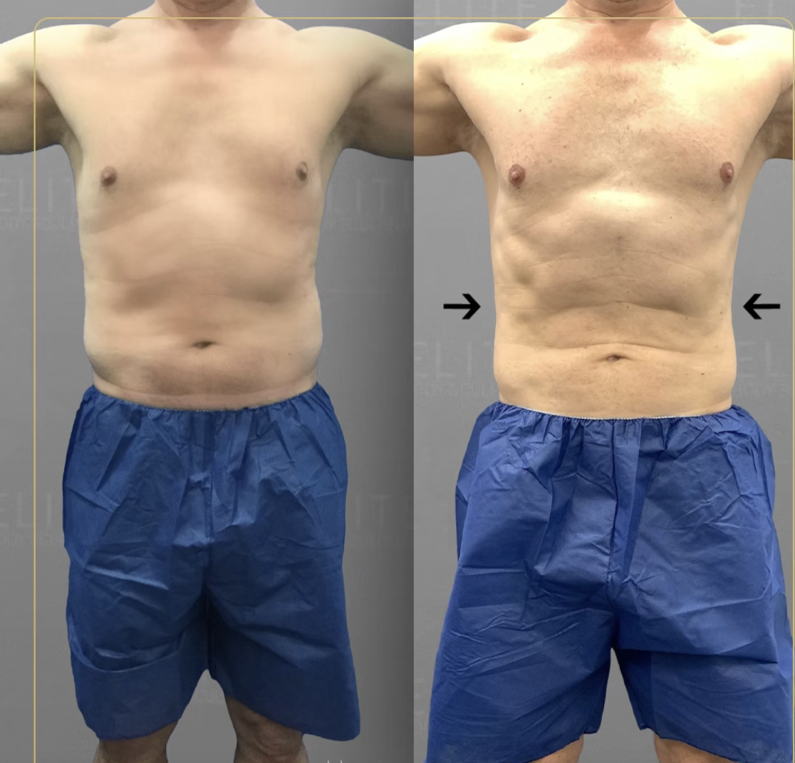 male lipo before after