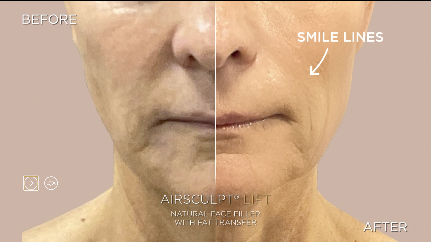 smile line before and after