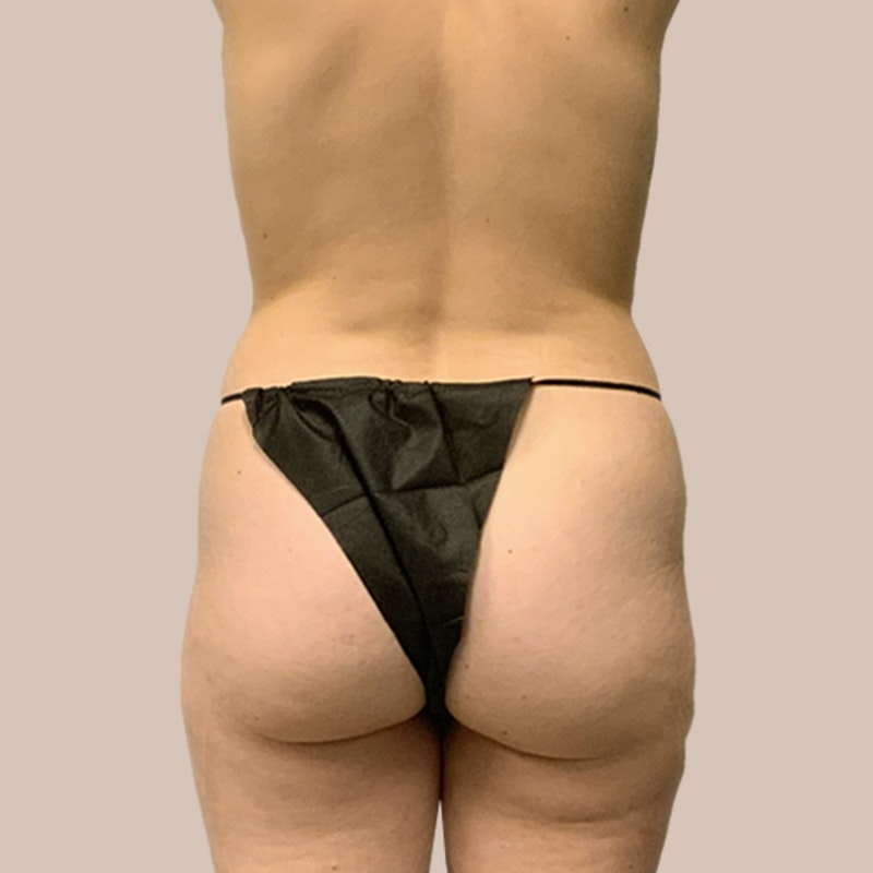 Back before airsculpt