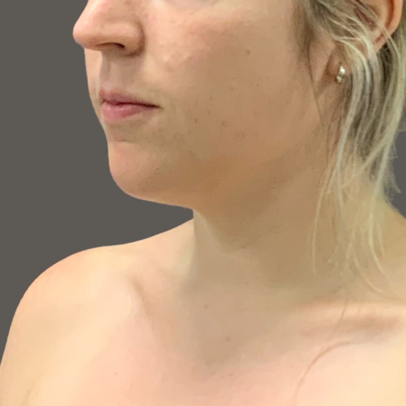 Before AirSculpt Lift