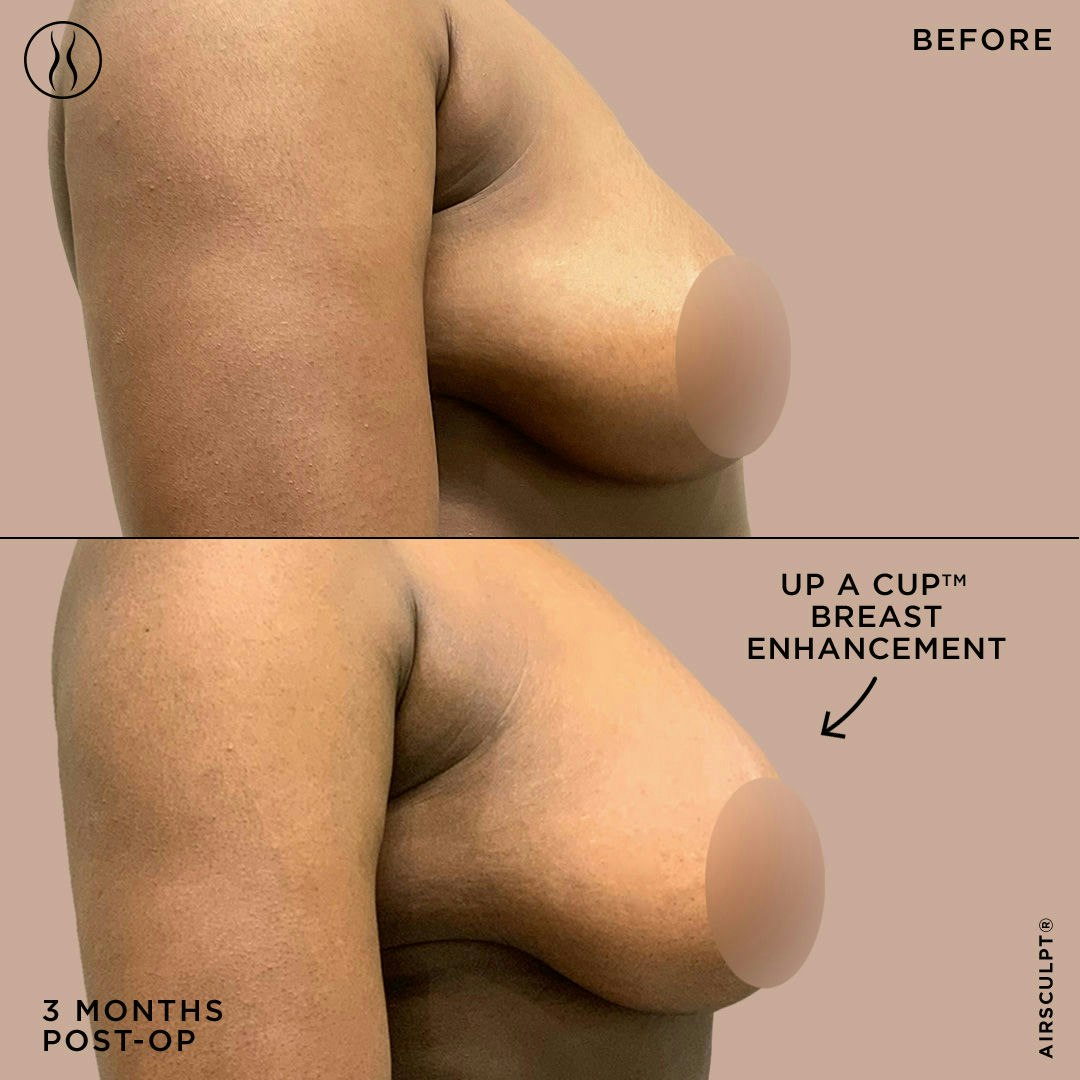 breast augmentation natural
