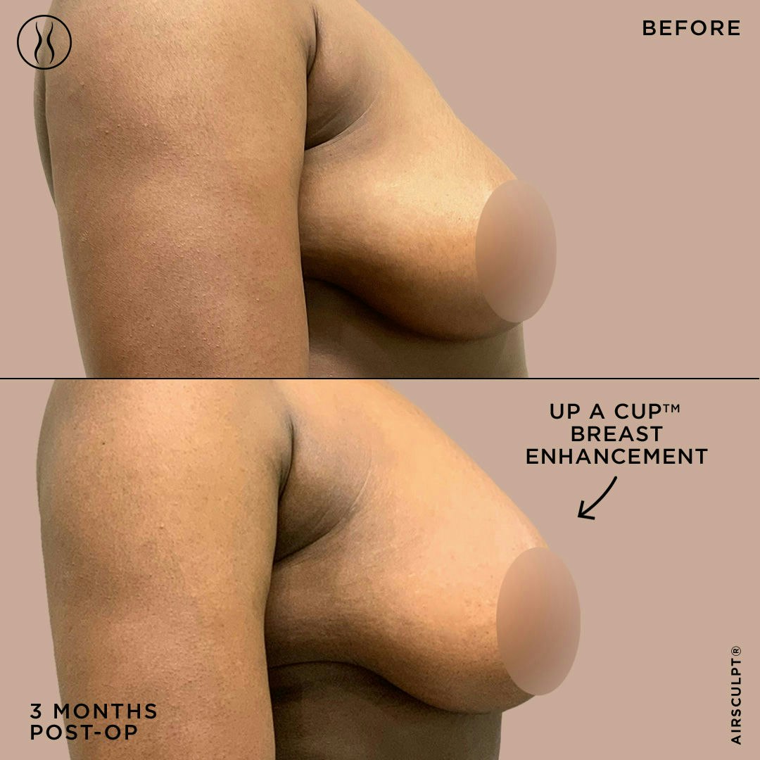 3 Reasons Why Natural Boobs Trump Implants