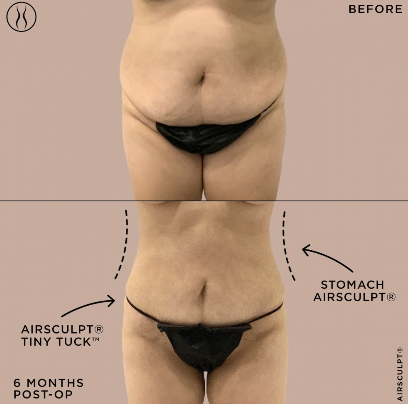 How to Get Rid of the Muffin Top: Exercises and Surgical Alternatives