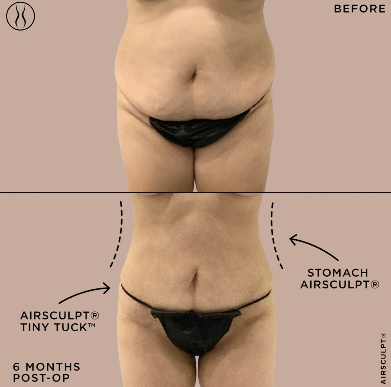 Struggling With Lipedema? Treat Yourself to AirSculpt®—Atlanta's