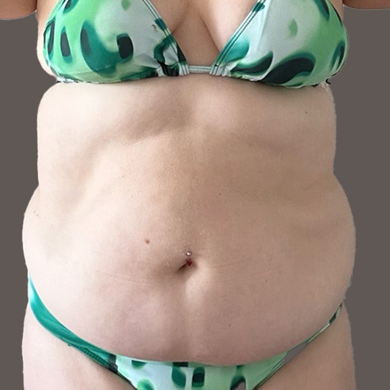 Stomach before airsculpt