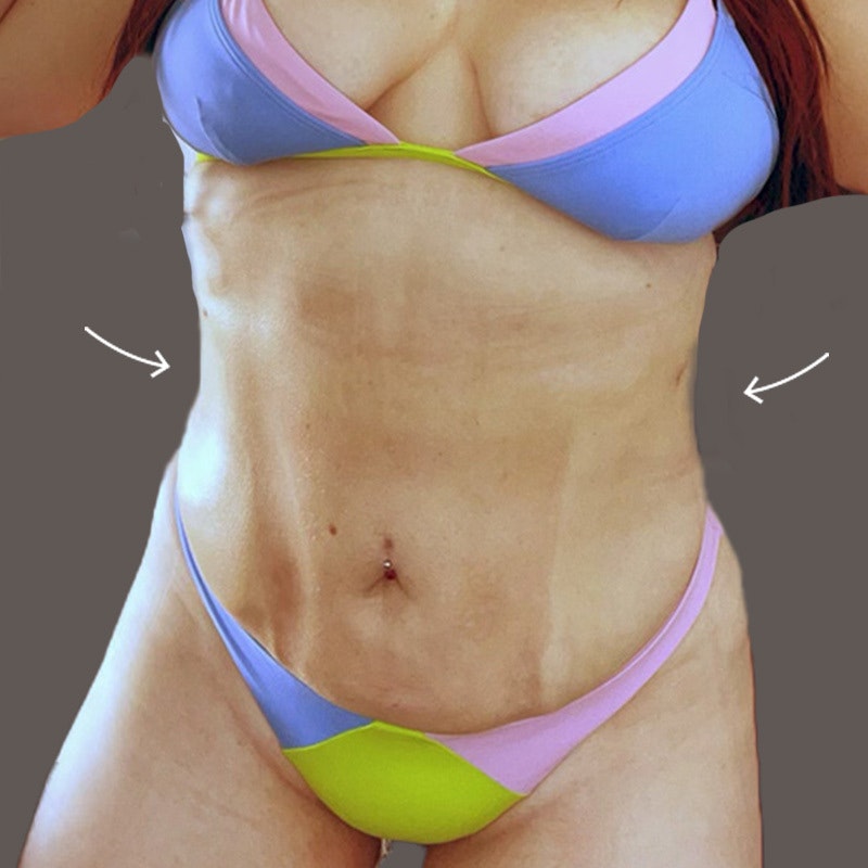 Stomach after airsculpt