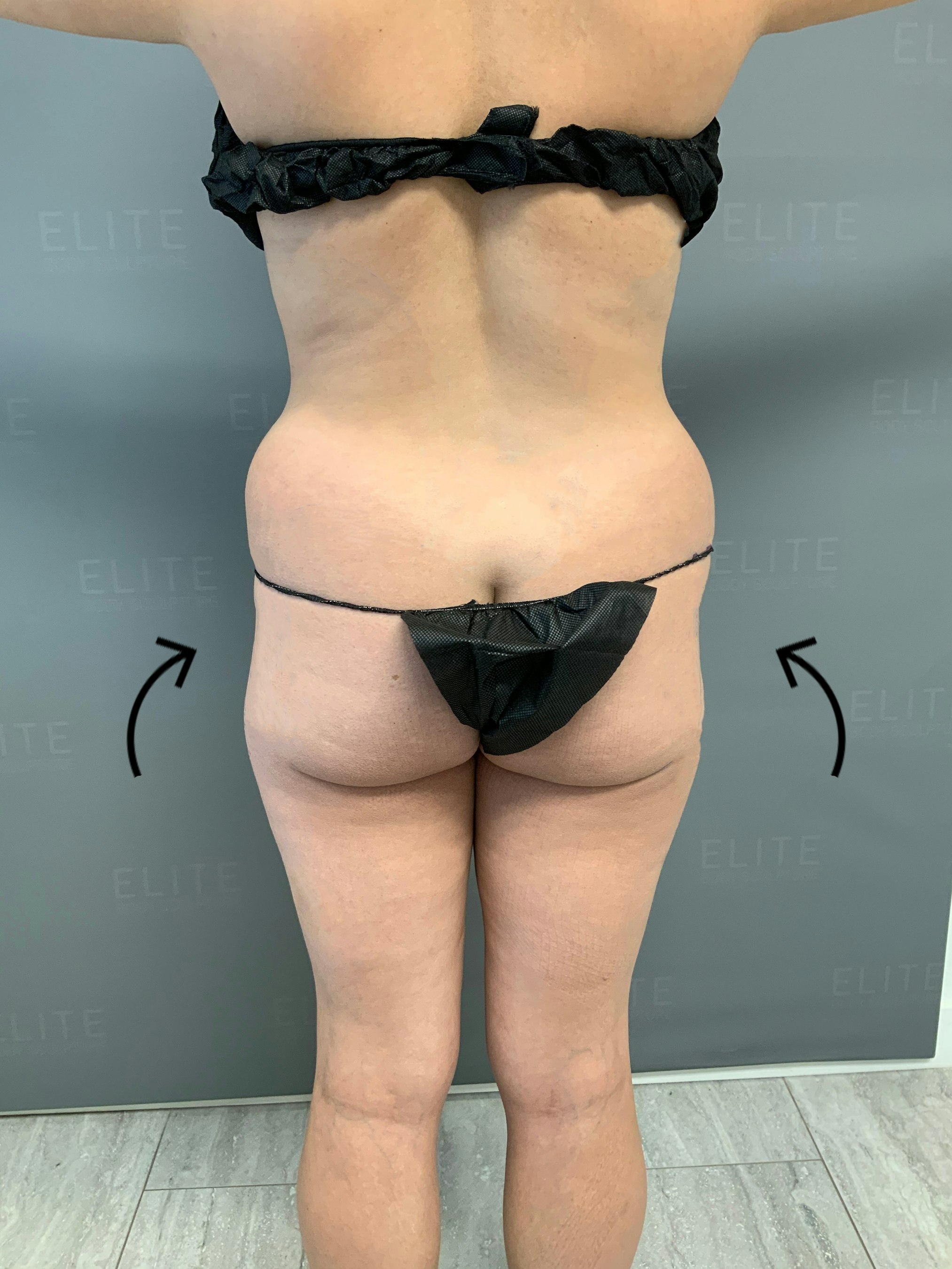 example of hip dips. image of woman's buttocks with arrows highlighting the hip dips