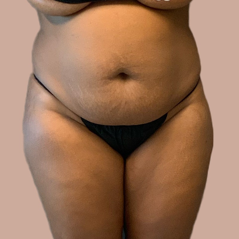Stomach before airsculpt