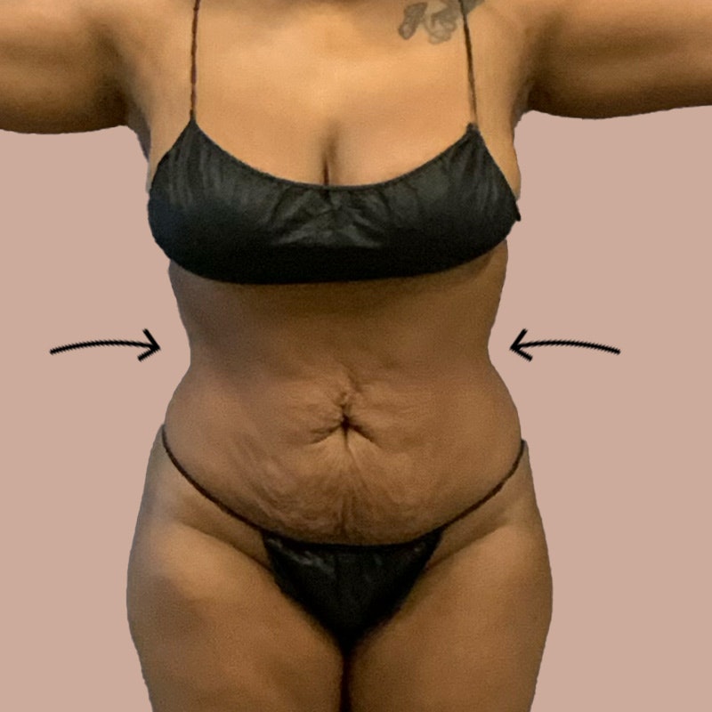 stomach after airsculpt