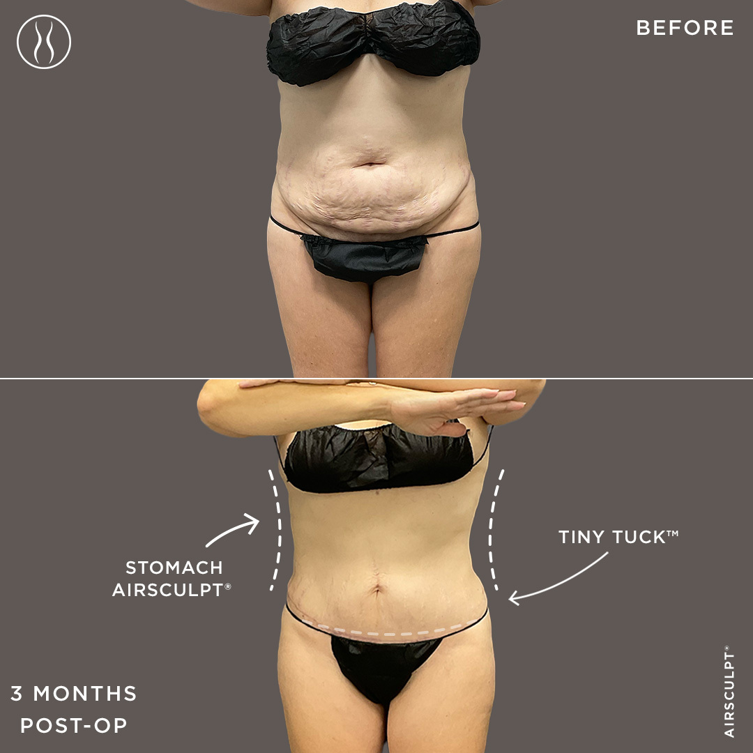 mini tummy tuck before and after 