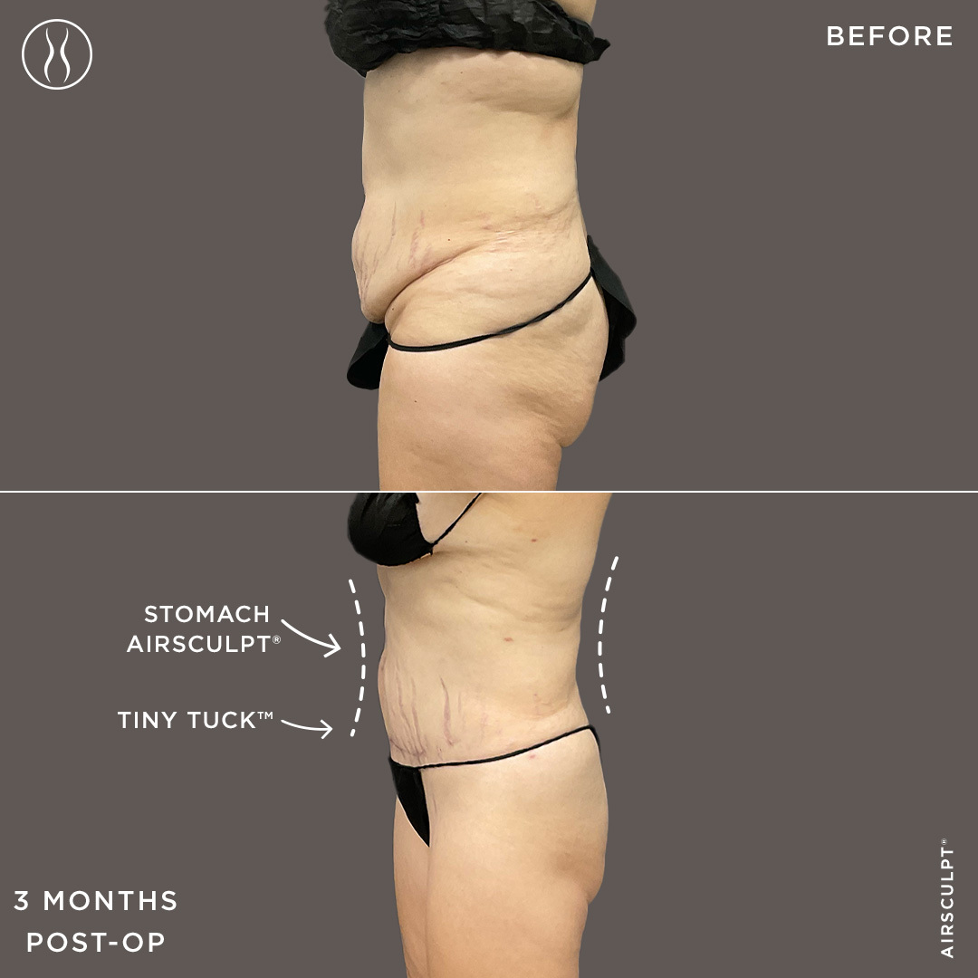 What is a Mini Tummy Tuck and How Does it Work?