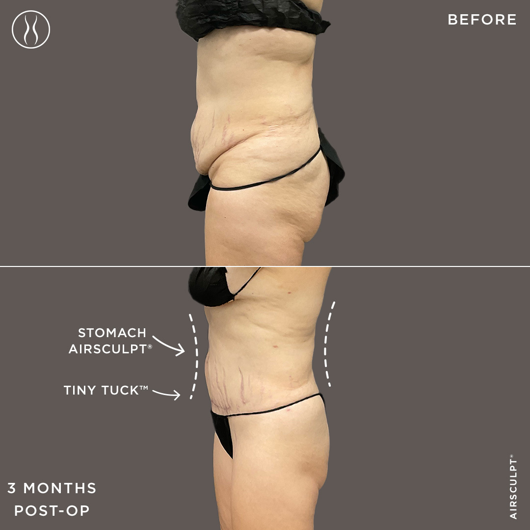 mini tummy tuck before and after 