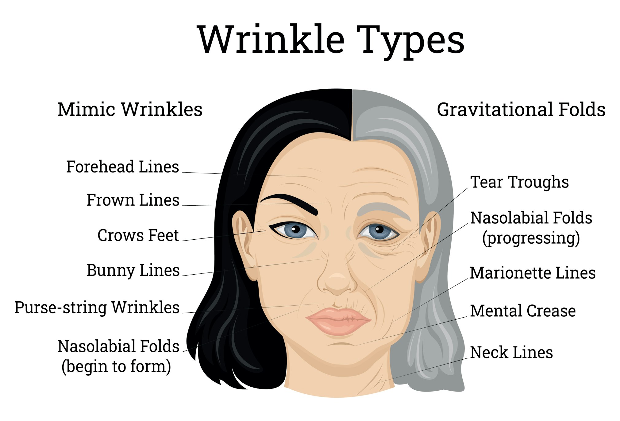 Wrinkle Types Illustration