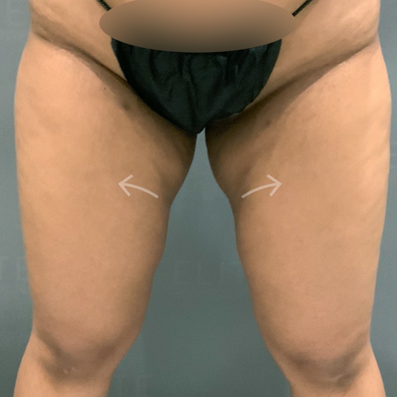 Orange County Inner Thigh Fat Removal