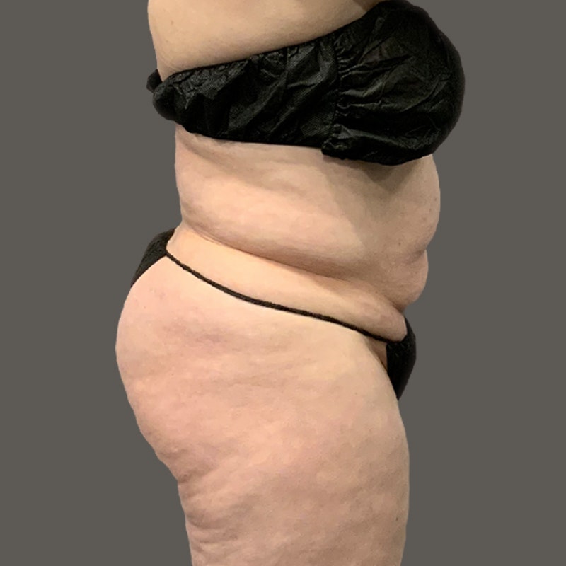 stomach befor airsculpt