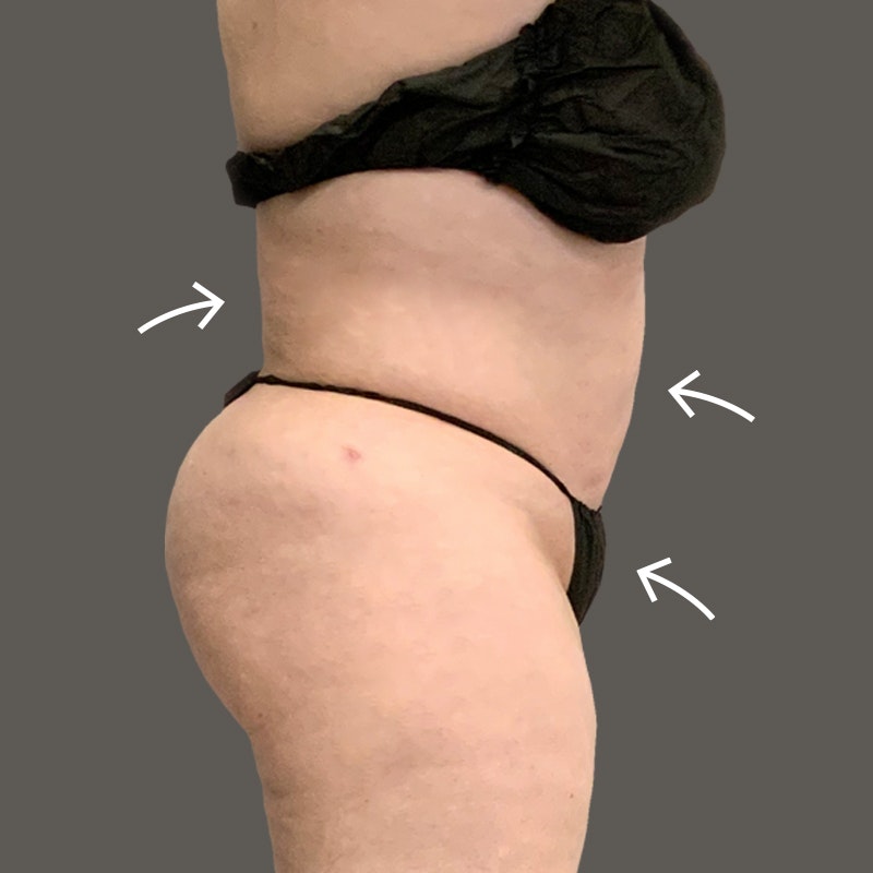 stomach after airsculpt