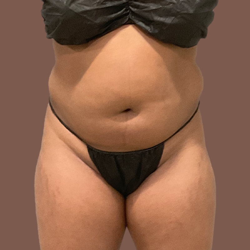 Stoamach before airsculpt