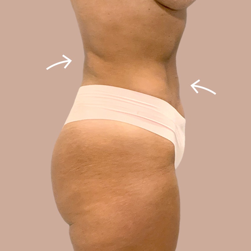 stomach after airsculpt