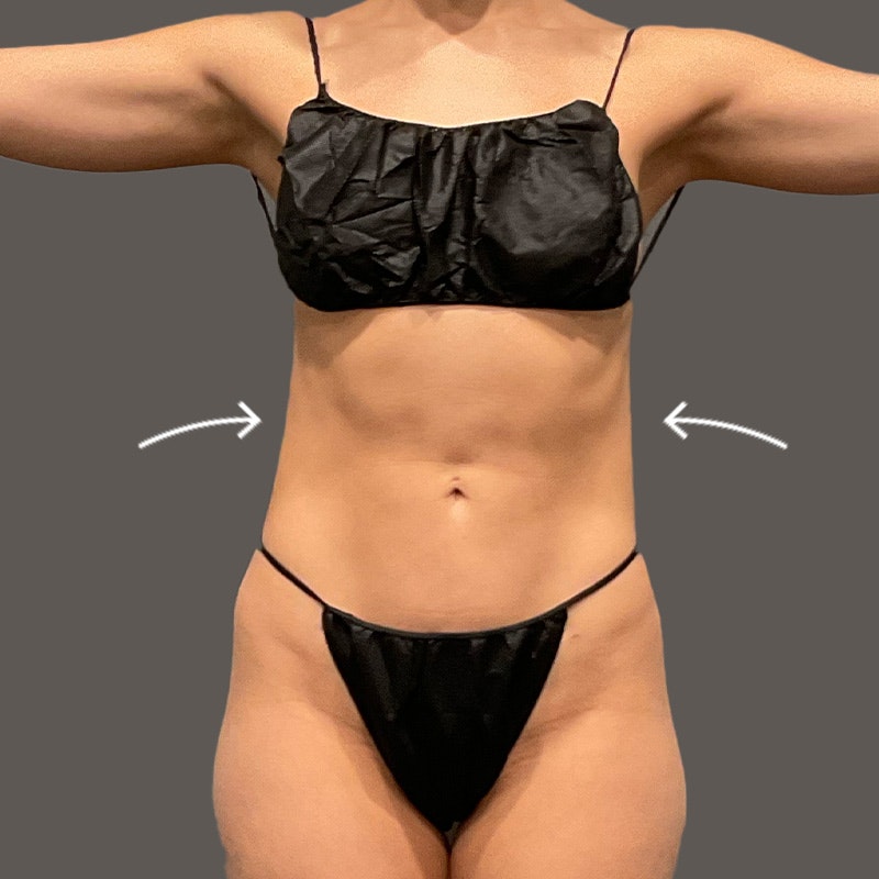 stomach after airsculpt