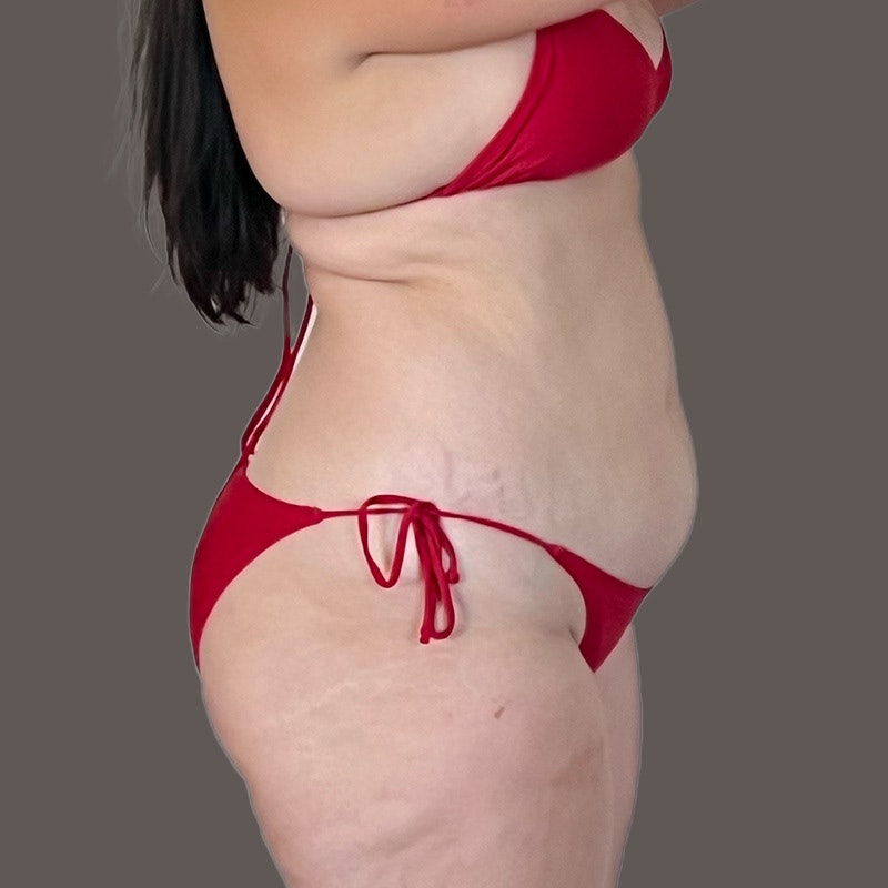 Stomach before airsculpt