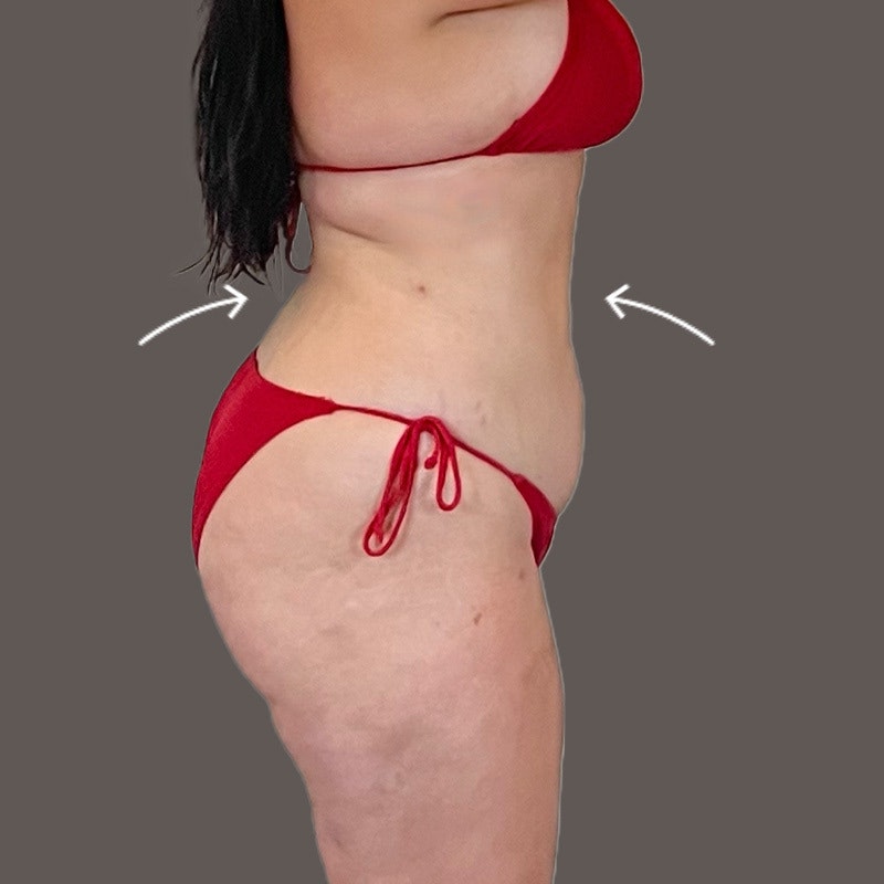 Stomach after AirSculpt