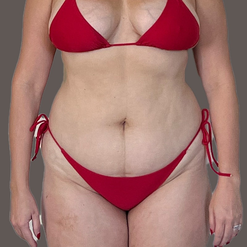Stomach before AirSculpt