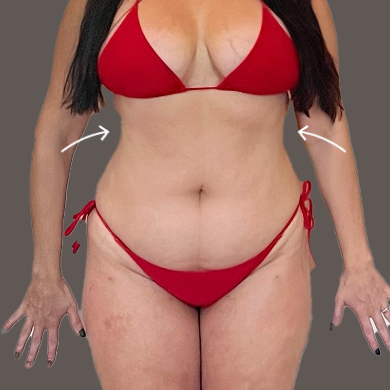 Stomach after AirSculpt