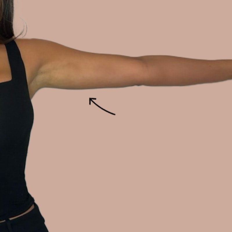 Arm after airsculpt