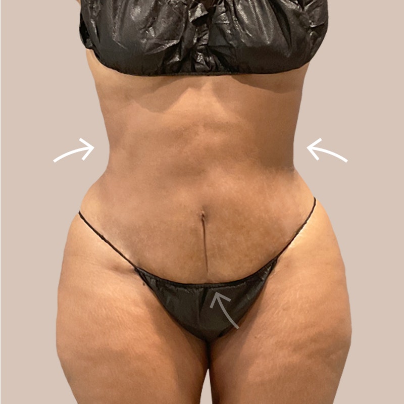 FUPA Mons Pubis Liposuction  Omaha Liposuction by Imagen