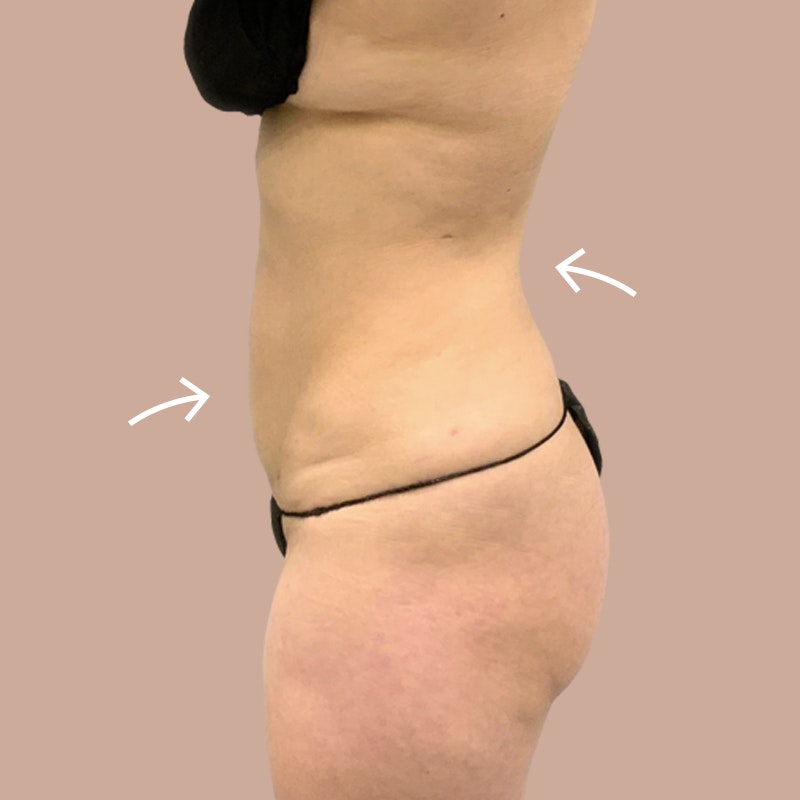 Boston Mons Pubis Liposuction  AirSculpt® Pubic Fat Removal