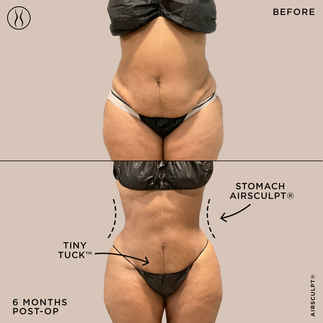 Are There Alternatives To A Tummy Tuck? - AHB