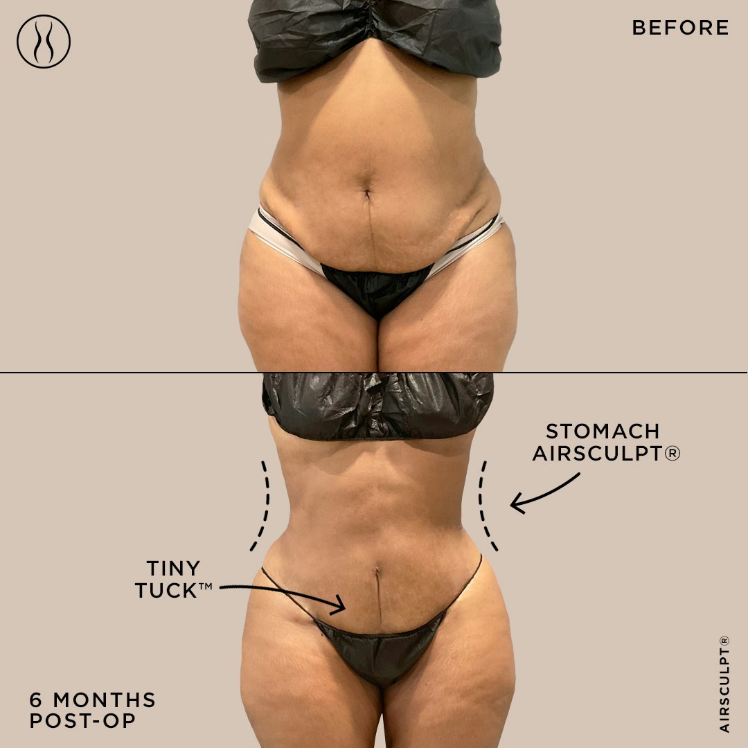 stomach airsculpt and tiny tuck before and after image – before on top featuring a hanging belly, after on bottom featuring a firm and flat stomach