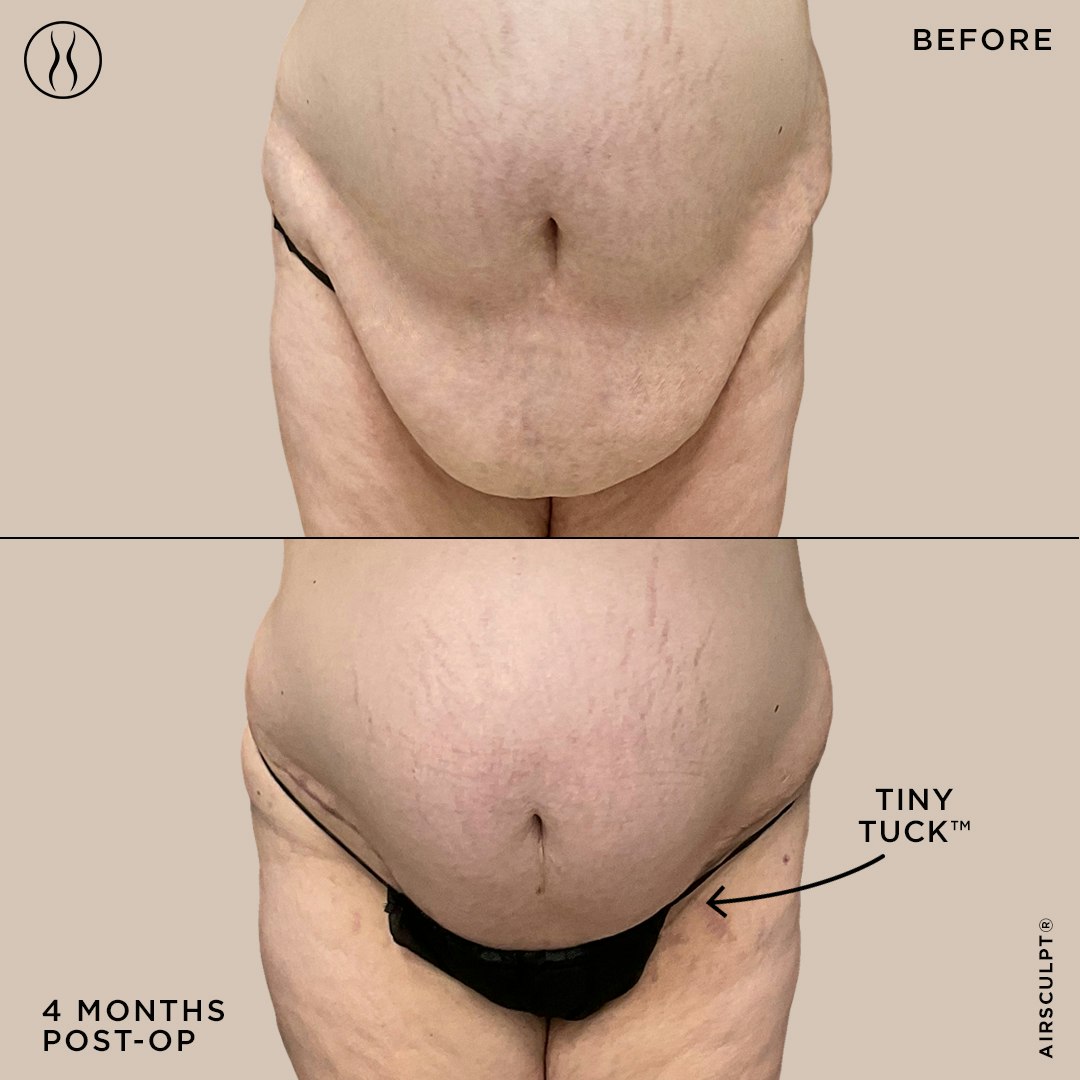 tiny tuck before and after image – before on top featuring a hanging belly, after on bottom featuring a firm and flat stomach