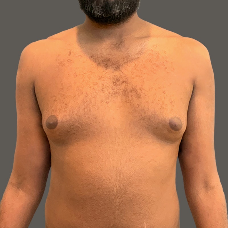 San Diego Breast Augmentation  AirSculpt® Implants Alternative