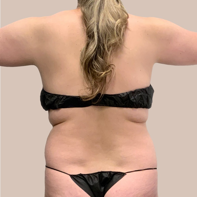 Back Bra Roll before AirSculpt