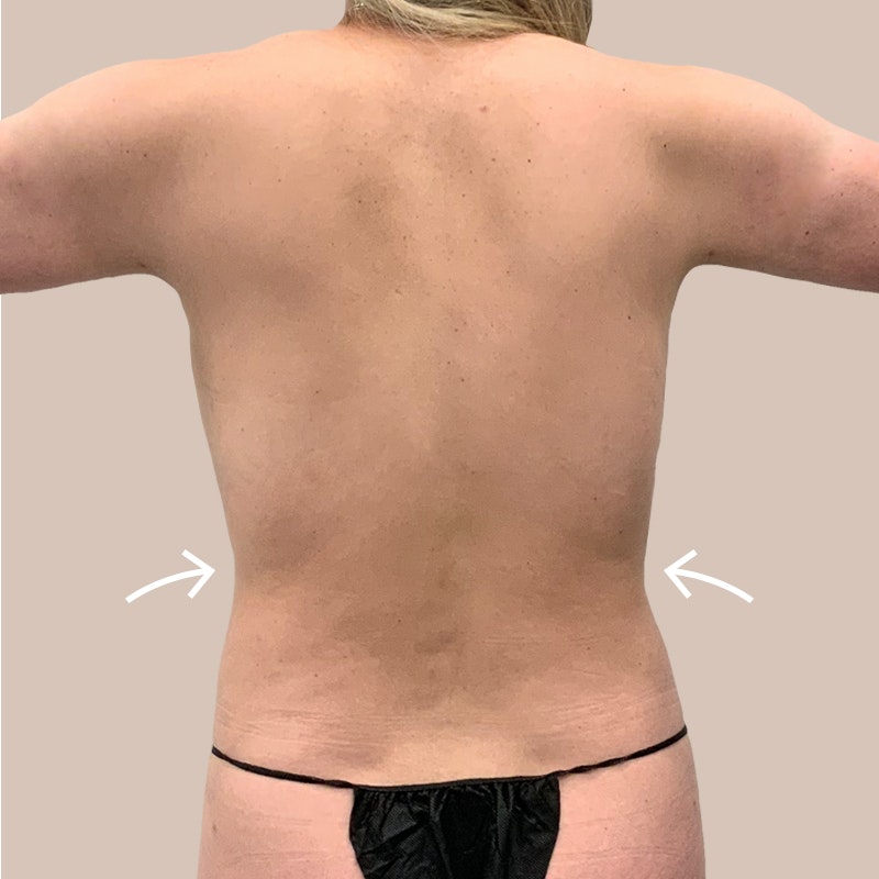Back Bra Roll after airsculpt