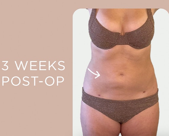 Kristen 3 week post-op