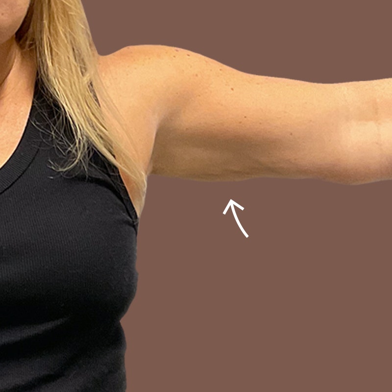 Arm after airsculpt