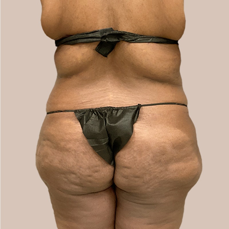 Back before airsculpt