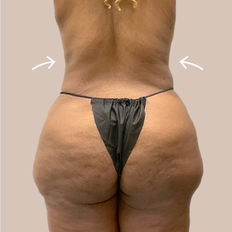 Back After AirSculpt