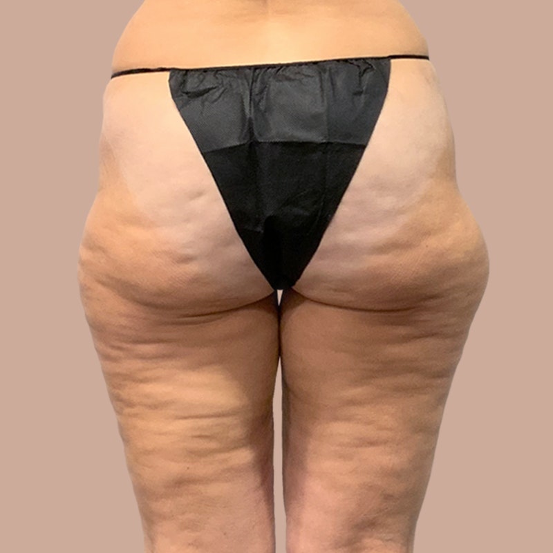 Thighs before airsculpt