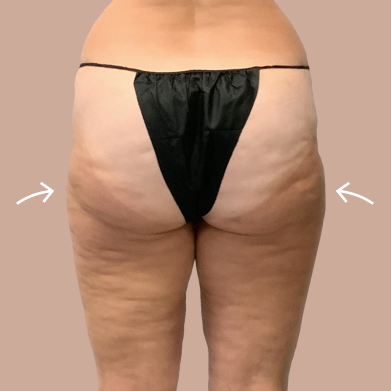 thighs after AirSculpt