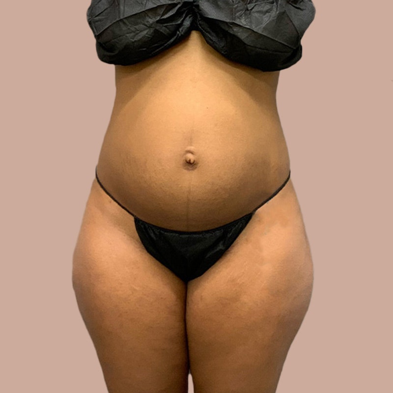 deleesa before stomach