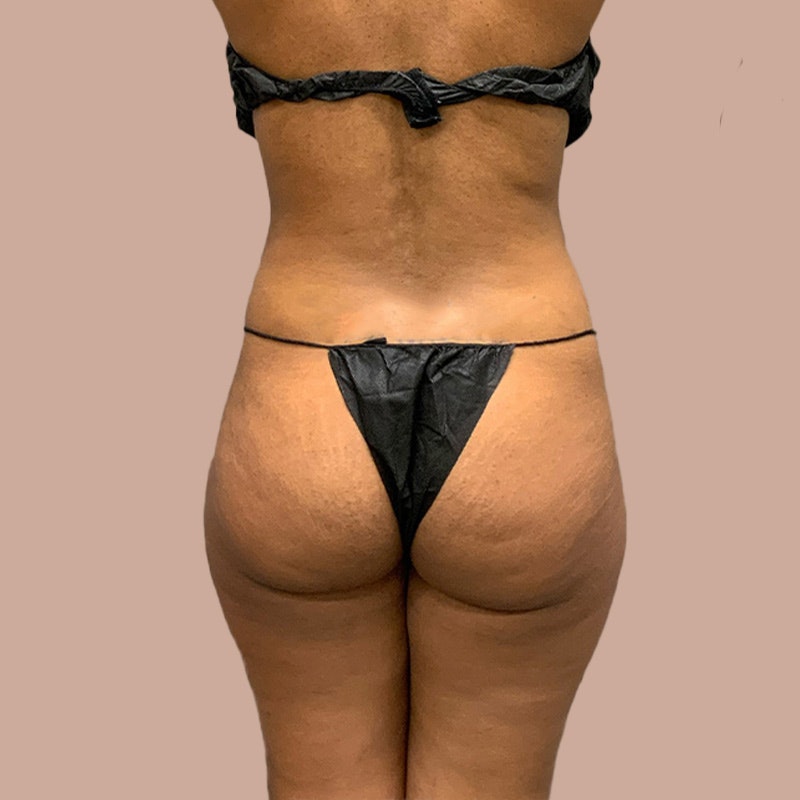 deleesa before back