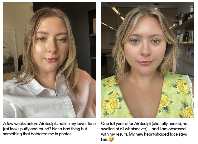 airsculpt before and after