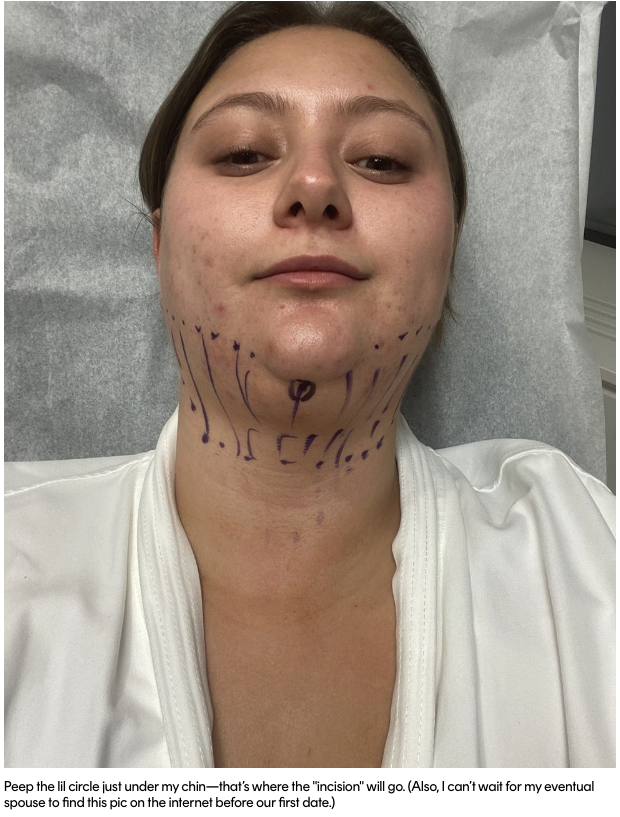 chin lipo before shot