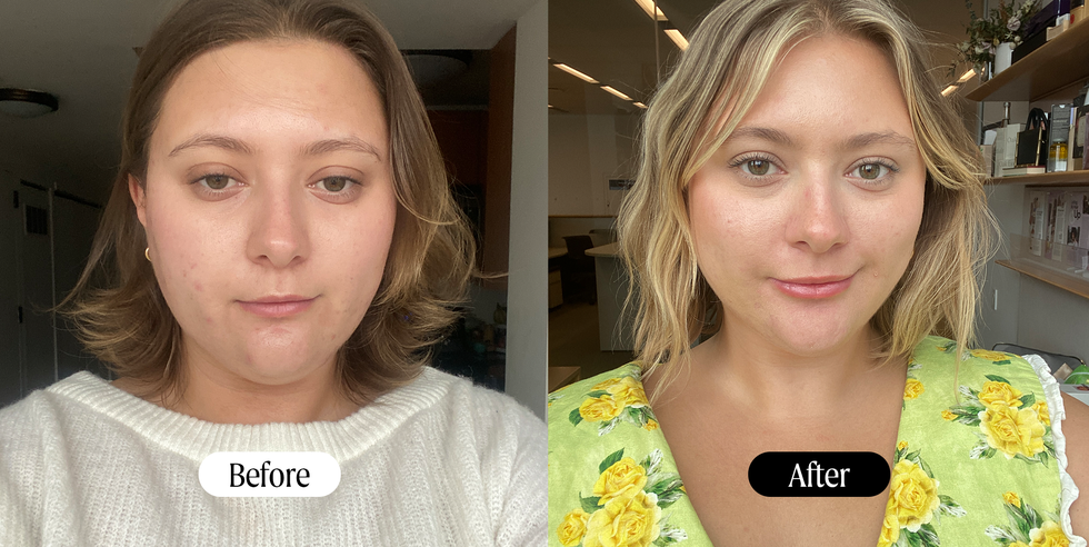 airsculpt before and after chin lipo