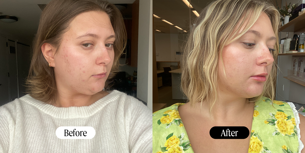 before and after chin airsculpt