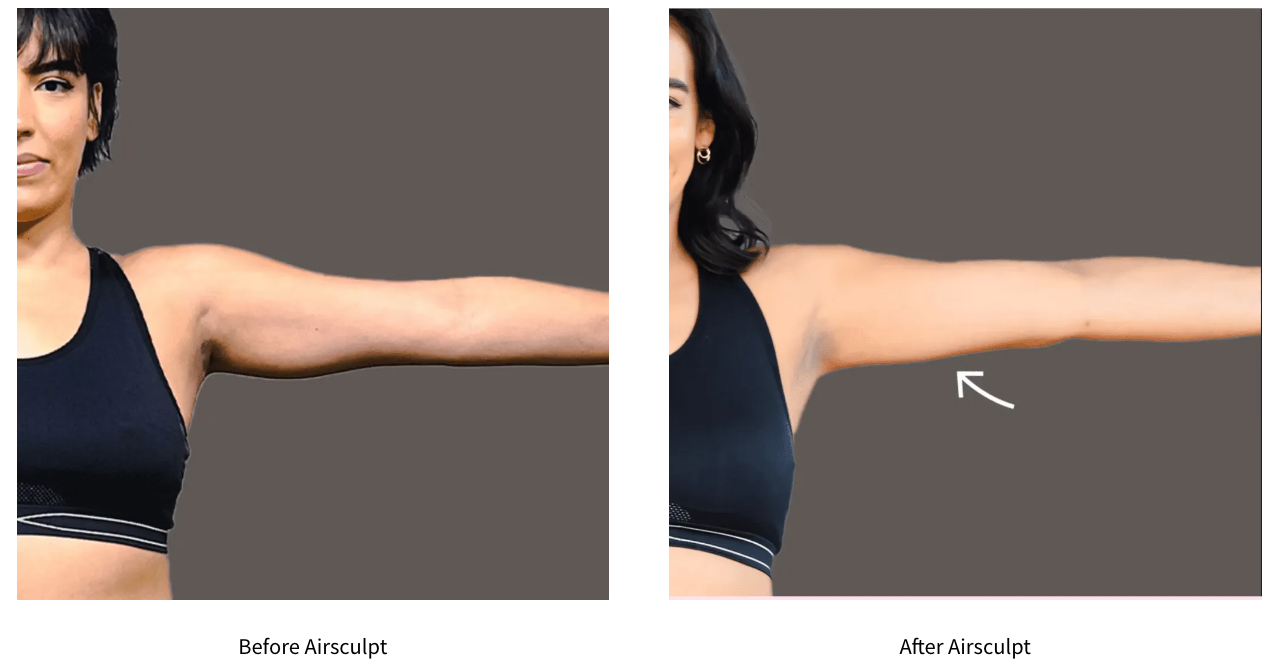 Danielle before and after arms results